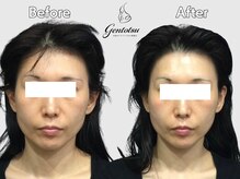 ゲントツ 新宿/小顔　小顔矯正