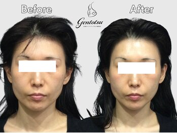 ゲントツ 新宿/小顔　小顔矯正