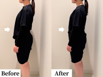 ソレア(Solea)/反り腰改善1回目