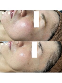 ナチュレ(Nature)/ハーブピーリングbefore→after