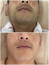 モット いこらもーる泉佐野店(mot)/メンズお顔脱毛