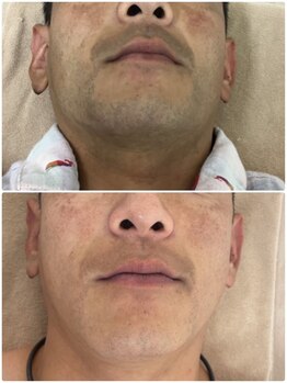 モット いこらもーる泉佐野店(mot)/メンズお顔脱毛