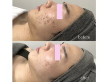 スピカ(Spica)/本気のハーブピーリング！