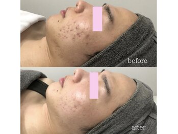 スピカ(Spica)/本気のハーブピーリング!