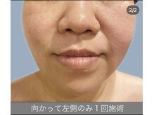 エラフリー/１回の施術で細キュッな輪郭に↑