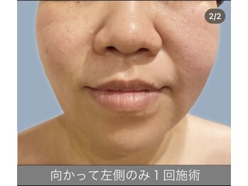 エラフリー/１回の施術で細キュッな輪郭に↑