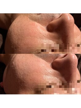 ルヴィショップ 沖縄(REVI SHOP)/毛穴の黒ずみも解消