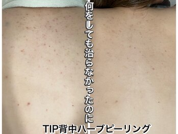 ハービー(Herbee)/背中ニキビケア!