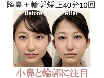 ラプリ 大阪心斎橋店(Raplit)/隆鼻＋輪郭矯正40分10回