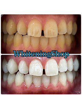 ホワイトニングショップ 吉祥寺店/BEFORE ＆ AFTER