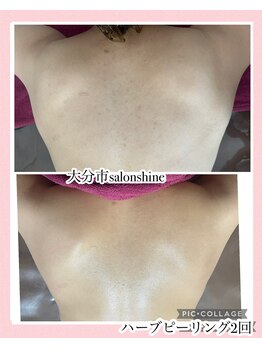 サロンシャイン(Salon Shine)/背中ハード2回