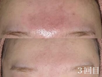 アワピール 天王寺店(AWA PEELL)/ハーブピーリング/ニキビケア