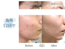 ディアスマイル(Dear.smile)/施術12回で
