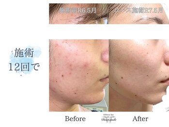 ディアスマイル(Dear.smile)/施術12回で