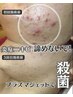 まずはお試し【ニキビ・凹凸肌改善】最新プラズマの力で肌悩みを改善！