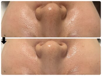 エフェクト 塚口店(effect)/Before After 30代/4回目