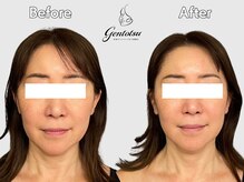 ゲントツ 新宿/小顔　小顔矯正