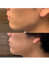 フェリーバ(FELIVA)/Before&After