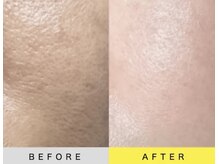 ソアン(Soin)/ダクトピール