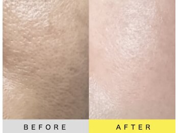 ソアン(Soin)/ダクトピール