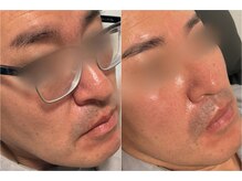 オーマイケア(Oh My Care)/HBL（ハリウッドブロウリフト）