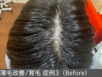 オアシスラグーン(OASIS LAGOON)/育毛促進(症例3 before)
