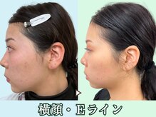 ナチュラルビューティーフェイス 横浜(NBF)/Ｅラインで悩む人向け