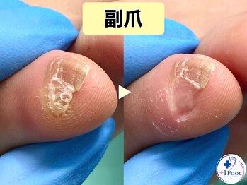 プラスワンフット 本厚木(+1 Foot)/小指の爪の変形と思っていた副爪