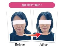 整骨院 壱/小顔矯正の変化