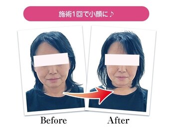 整骨院 壱/小顔矯正の変化