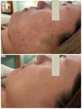 リリー(Rily)/ニキビケア毛穴特化サロン