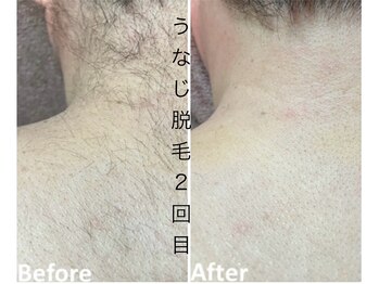 CDF 赤坂/全身脱毛2回目初回16500