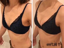 リール 新宿店(RIRE)/40代前半　バストアップ症例