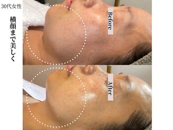 ヴィタベラ(Vita Bella)/WINBACKフェイシャル+ラミピ