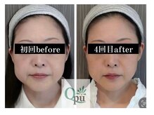 キュープ 大阪中百舌鳥店(Qpu)/小顔のサポートいたします