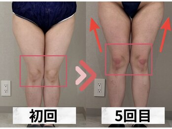 イヨヨ(iyoyo)/【痩身】Before After