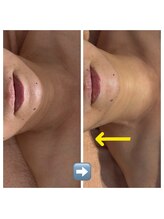 ルソワン(Le.soin)/顔や首周りもスッキリ！小顔に