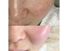 アンノン(Annon)/臍帯羊膜幹細胞×エラスチン症例