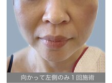 エラフリー/筋肉と皮膚レベルでリフトアップ