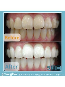 グロウ グロウ(grow.glow)/ホワイトニング仙川