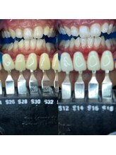 トウキョースワーズ 渋谷店(TOKYO SWRS)/#ホワイトニング #渋谷 #池袋