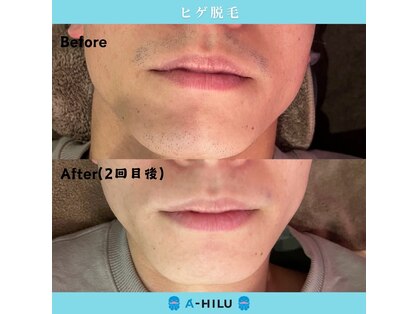アーヒル(A”-HILU)の写真
