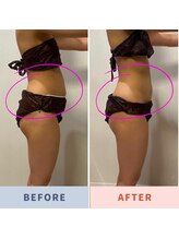 レビーリズ バイ サロンリーナ(Revie Liz)/お腹集中症例