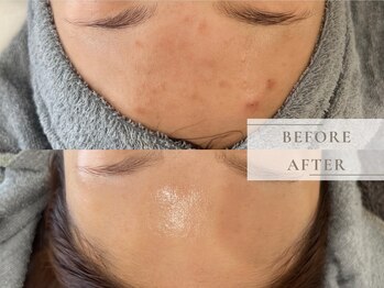 レヴィア(Revia)/ハーブピーリングでニキビケア