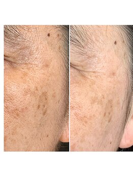 ヴィオテラス(VIOTERACE)/韓国ハイクラストリートメント１