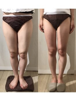 プルーラントエステ キョウト ビジョーラ(PullulantEsthe Kyoto×BEJORA)/痩身10回ビフォーアフター