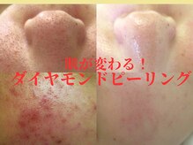 サロンドエステケイワイ(de KY)の雰囲気（他店で変わらなかった毛穴・ニキビに、ダイヤモンドピーリング）