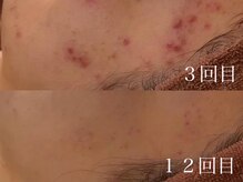 アワピール 天王寺店(AWA PEELL)/ハーブピーリング/ニキビケア