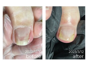 Hey!Swichi 巻爪ケア♪