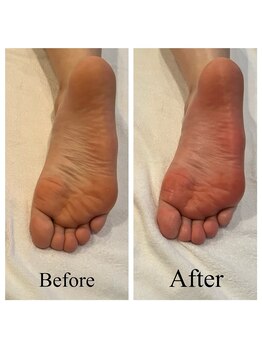 リラクゼーションサロンネロリ/足裏インディバ　末端冷え性